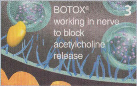 botulinum toxin Process 3